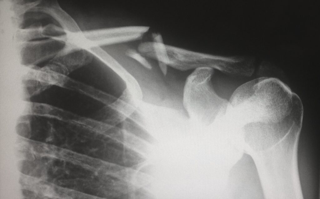 Personal Injury Case Process in Arizona