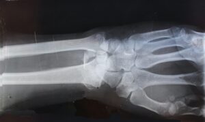 What Are Compensatory Damages?